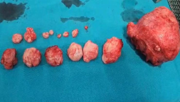 Karnındaki şişkinlik ve ağrının sebebi belli oldu: 16 adet miyom