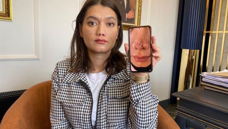 1 milyon liralık estetik davası: ‘Hayatım komple karardı’